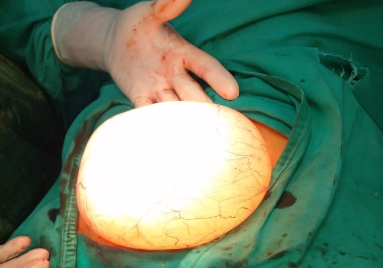 Successful Precise Surgery at Royal Hospital to Remove an Ovarian Tumor Weighing Approximately 1.650 kg